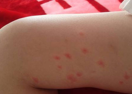 武汉跳蚤肆虐！室内灭治跳蚤与跳蚤咬伤处理方法！